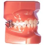 MARA-appliance  - Braces and Invisalign in Kansas City, Overland Park, Olathe, and Paola, Kansas - Oltjen Orthodontics
