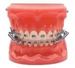 forsus  - Braces and Invisalign in Kansas City, Overland Park, Olathe, and Paola, Kansas - Oltjen Orthodontics