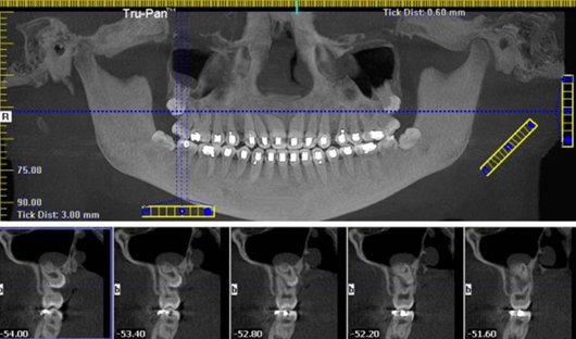 icat-3-1  - Braces and Invisalign in Kansas City, Overland Park, Olathe, and Paola, Kansas - Oltjen Orthodontics
