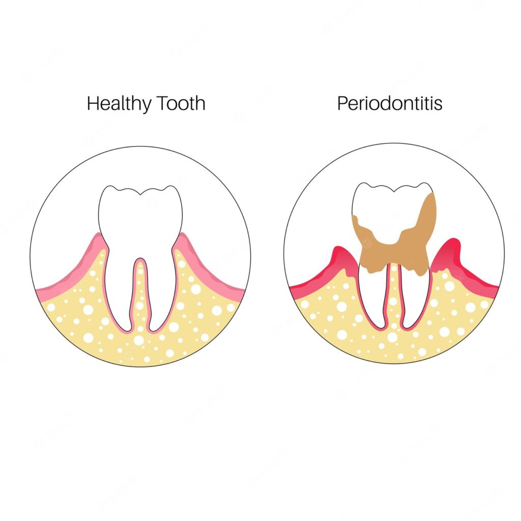 periodontitis periodontitis-1024x1024 - Braces and Invisalign in Kansas City, Overland Park, Olathe, and Paola, Kansas - Oltjen Orthodontics