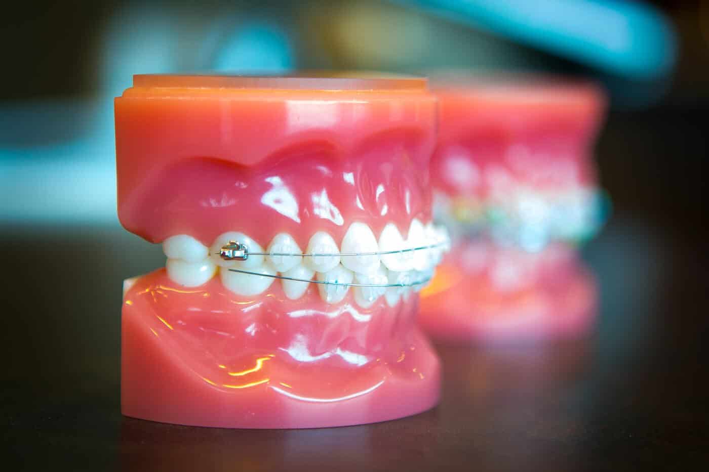 Clear Braces in Olathe & Overland Park, KS